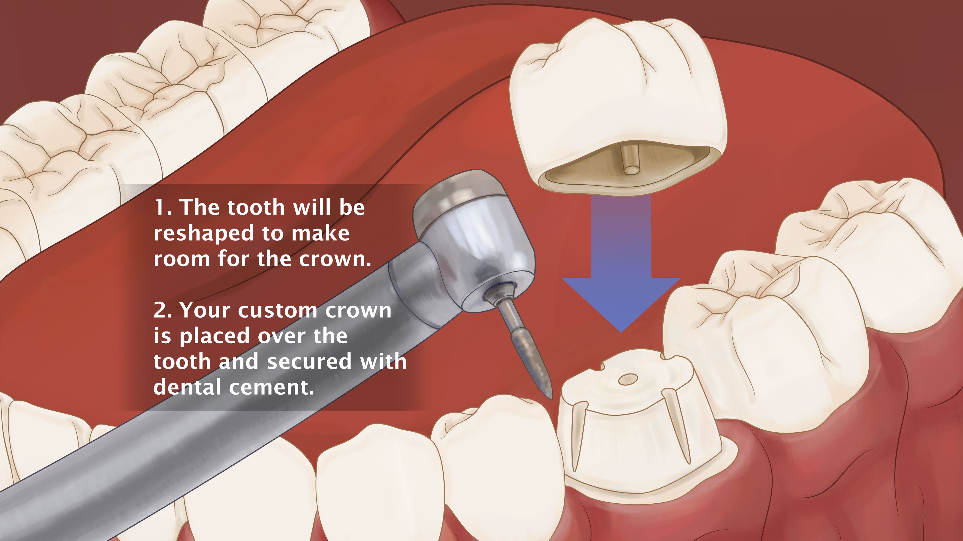 Placing a dental crown