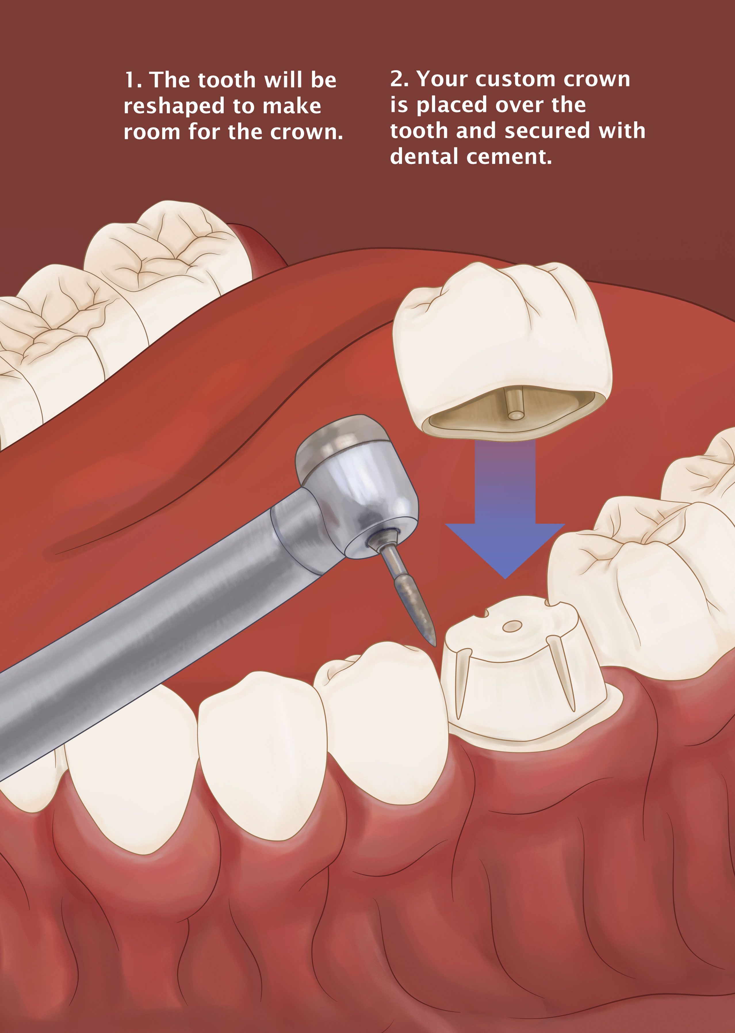 Placing a dental crown
