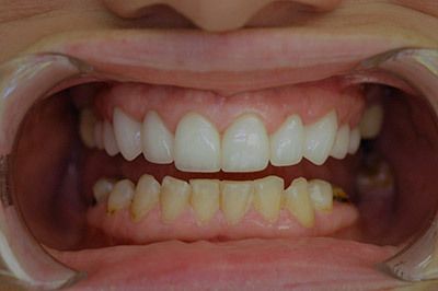 after full mouth reconstruction