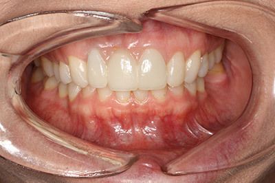 patient after full mouth reconstruction