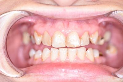 before full mouth reconstruction